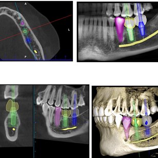 3D Implant Planning